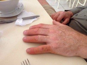 No, no, Don wasn't going to the tanning booth just for his fingers...12 hours per day in the sun plus doxycyline is NOT a good combination!  